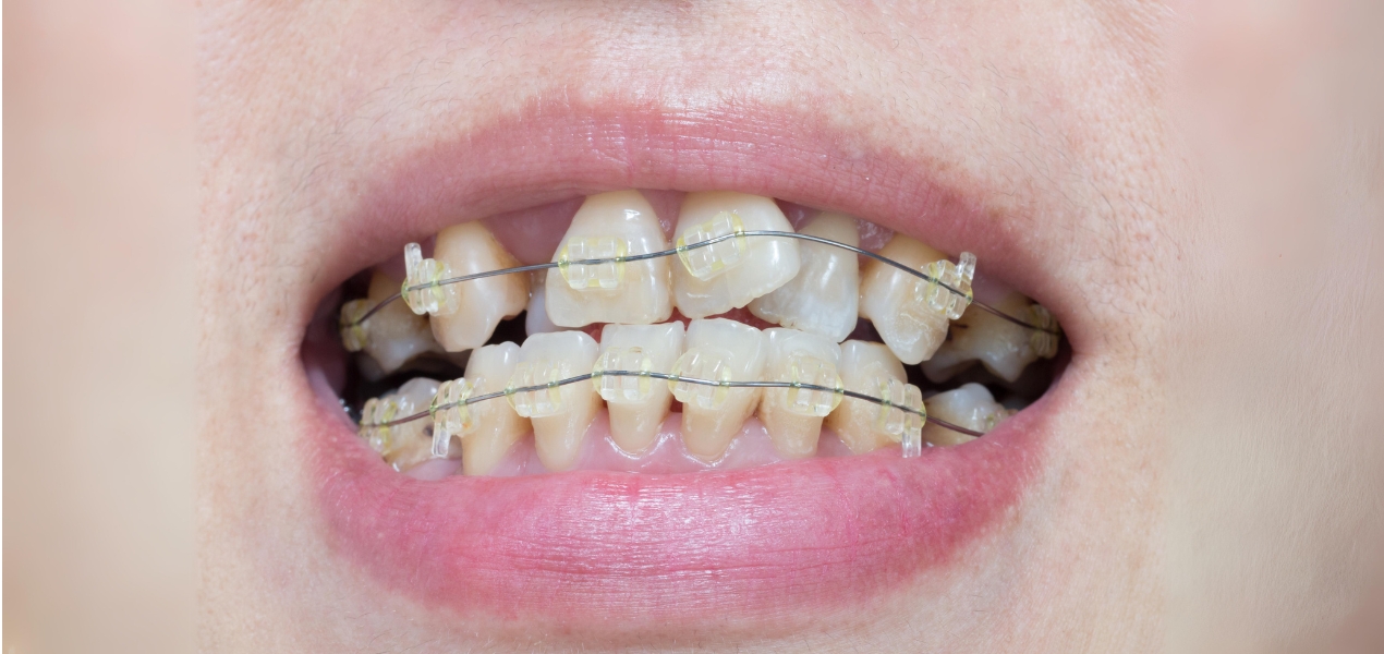 Penyebab Umum Gigi Tumbuh Miring dan Cara Mengatasinya