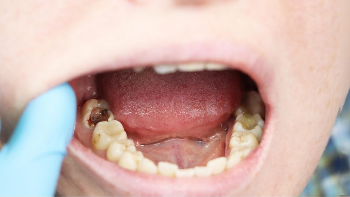 Ternyata Seperti Ini Penyebab dan Proses Gigi Berlubang